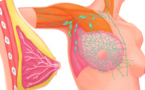 ابتكار طريقة جديدة تروم الحد من انتشار خلايا سرطان الثدي
